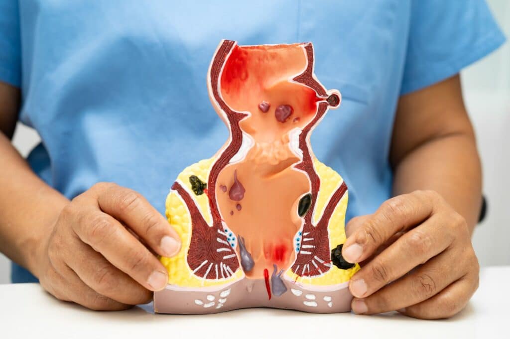 αιμορροΐδες αντιμετώπιση στο σπίτι